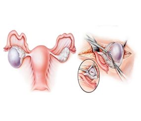 Ovarian Drilling