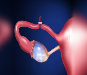 Tubal Ligation